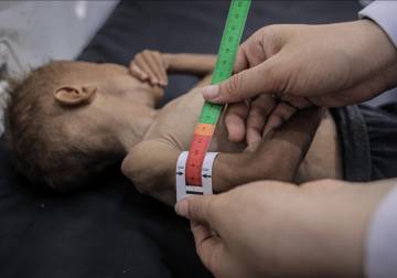 يونيسف: 9 آلاف طفل دون 5 سنوات في غزة يعانون سوء تغذية حاد