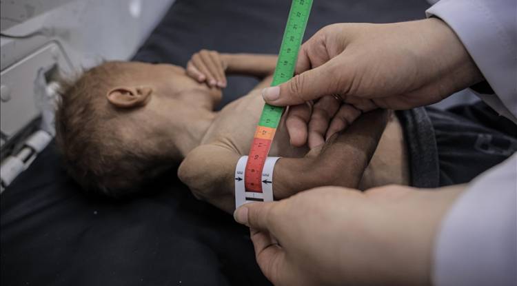 يونيسف: 9 آلاف طفل دون 5 سنوات في غزة يعانون سوء تغذية حاد